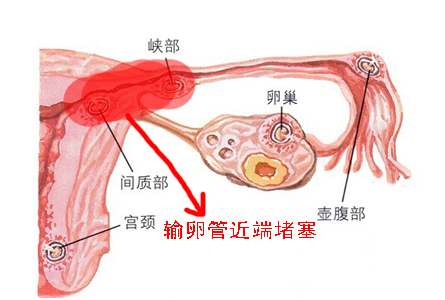 輸卵管堵塞的相關(guān)知識，大多數(shù)人都不知道這個！